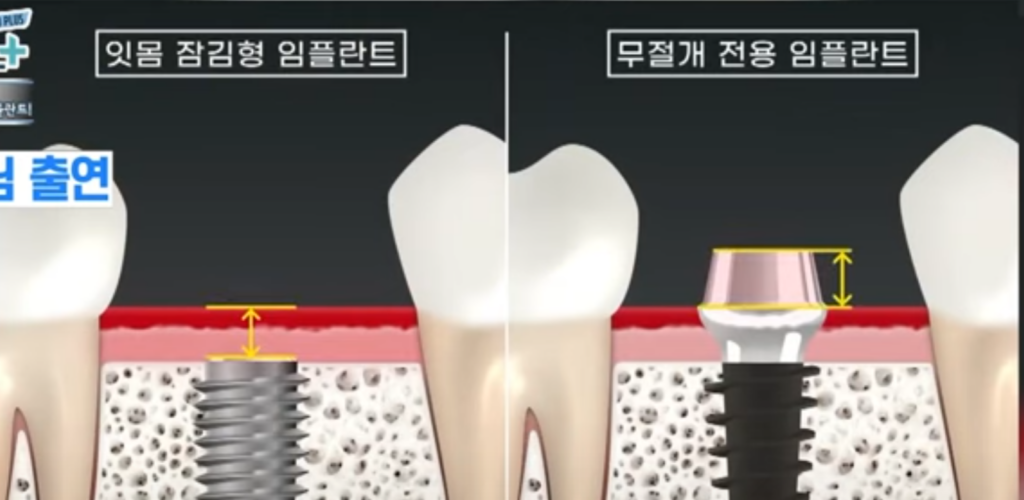 임플란트29만원하루