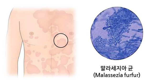 니조랄 사용법